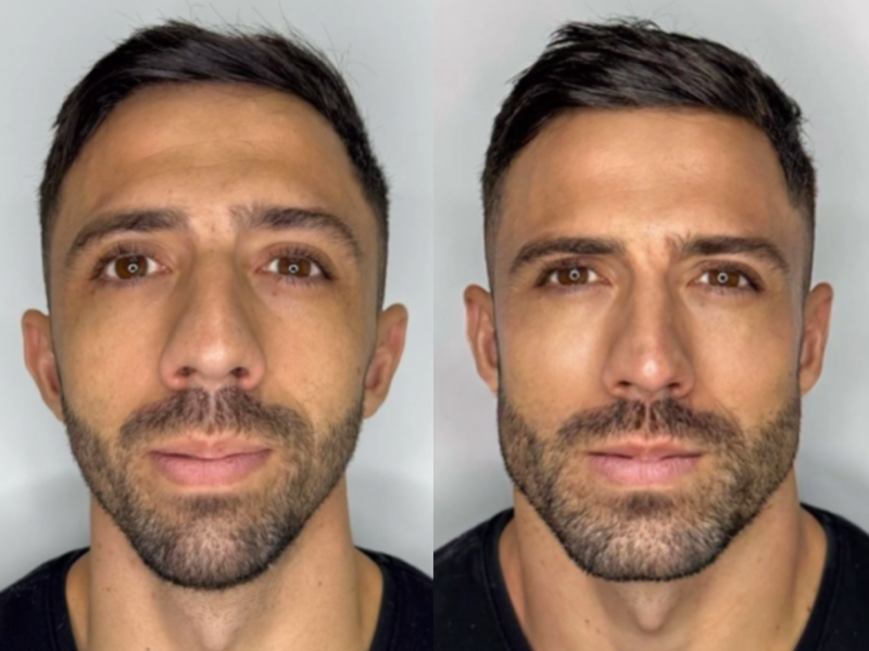 Harmonização Facial