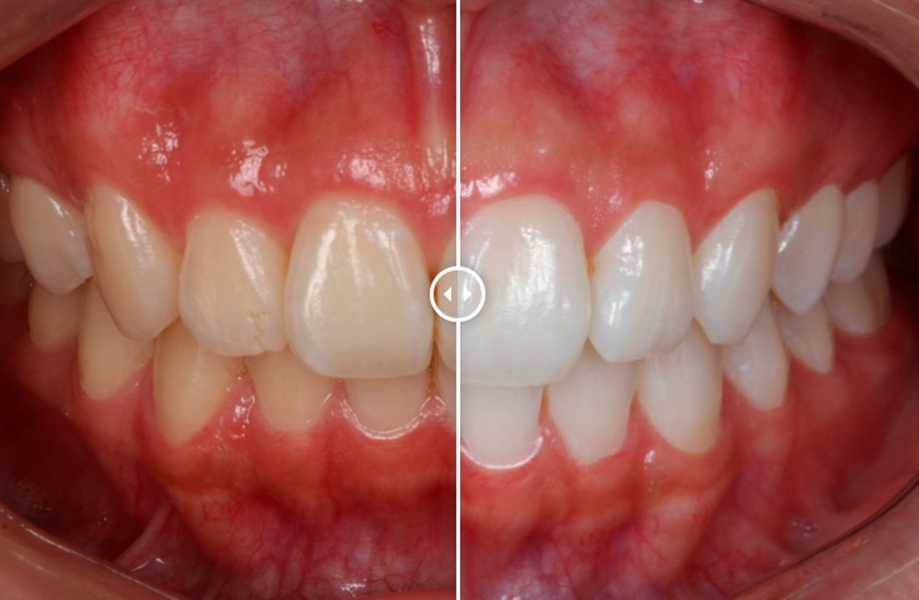 Clareamento Dental