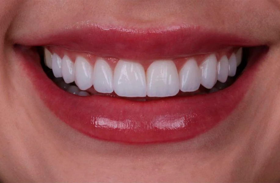 Lente de Contato Dental