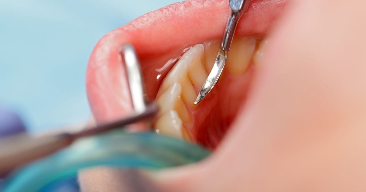 Limpeza e Prevenção na Sorriliê Clínica Odontológica em Senador Canedo